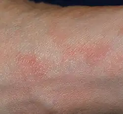 Scabies of the foot