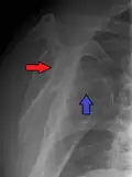 Anterior dislocation of the right shoulder. Y view X ray.
