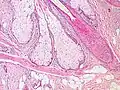 Base of pilosebaceous unit