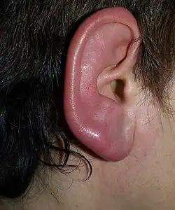 Redness and swelling of an ear
