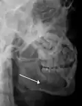 lateral oblique image demonstrating a fractured mandible.