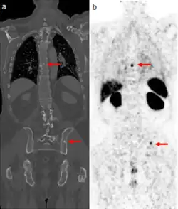 Medical images of a man's torso. Arrows indicate tumor metastases, visible as dots in the man's spine and pelvis, in both scans.