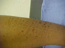 Thick, fish-like scales on an adult lower leg