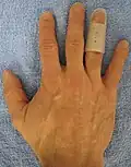 An example of a splint for mallet finger.