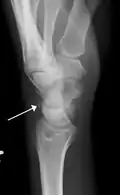 Triquetral fracture as seen on lateral view of a radiograph.